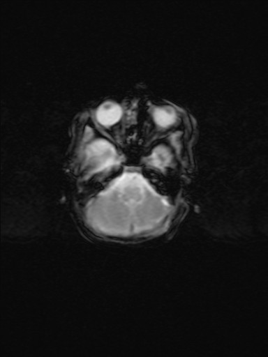 File:Neonatal hypoxic-ischemic encephalopathy (Radiopaedia 41406-44277 Axial Gradient Echo 16).jpg