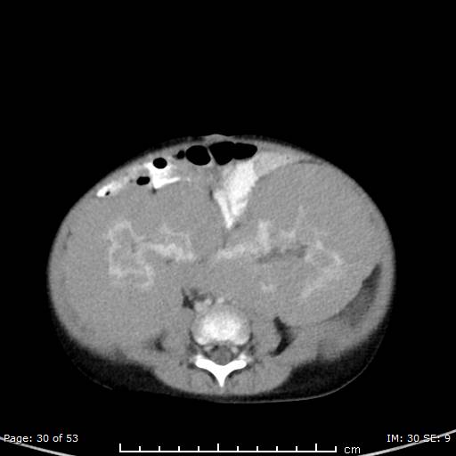 File:Nephroblastomatosis (Radiopaedia 41934-44935 A 30).jpg