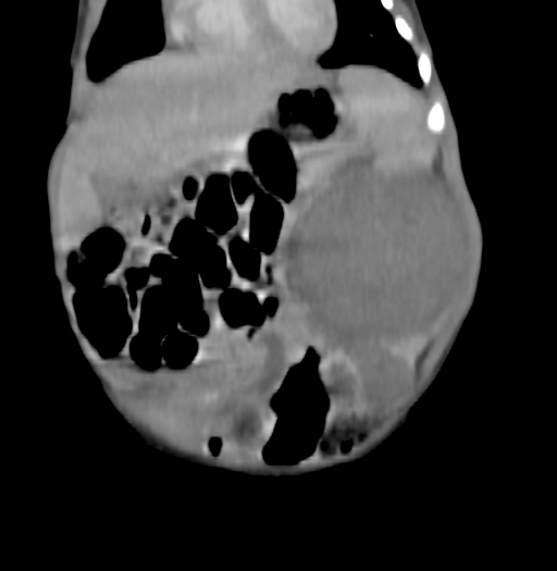 Nephroblastomatosis (Radiopaedia 71294-81607 B 111).jpg