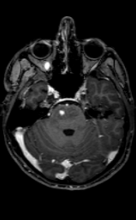Neuro-Behçet disease (Radiopaedia 90112-107294 Axial T1 C+ 162).jpg