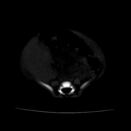 File:Neuroblastoma (Radiopaedia 20876-20799 Axial bone window 18).jpg