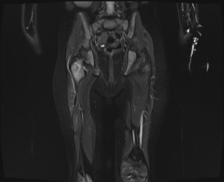 File:Neuroblastoma with bone metastases (Radiopaedia 67080-76414 Coronal STIR 16).jpg