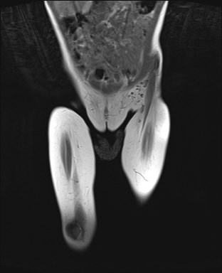 File:Neuroblastoma with bone metastases (Radiopaedia 67080-76414 Coronal T1 3).jpg