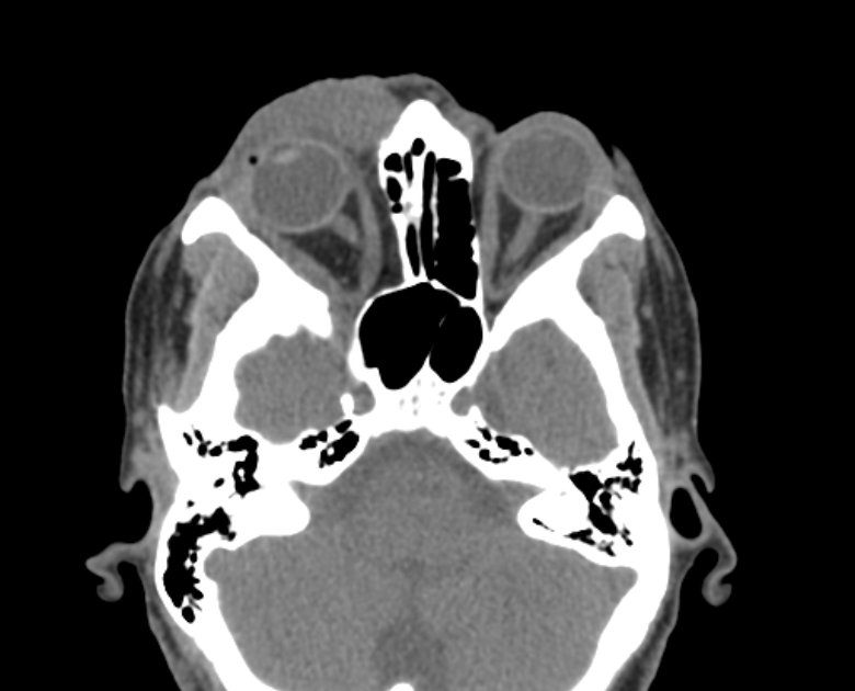 Neurofibromatosis type 1- orbital manifestations (Radiopaedia 49391-54511 Axial non-contrast 48).jpg