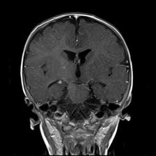 File:Neurofibromatosis type 1 (Radiopaedia 30089-30671 Coronal T1 C+ 15).jpg