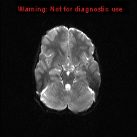 File:Neurofibromatosis type 1 with optic nerve glioma (Radiopaedia 16288-15965 Axial DWI 15).jpg