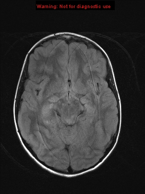 File:Neurofibromatosis type 1 with optic nerve glioma (Radiopaedia 16288-15965 Axial FLAIR 15).jpg