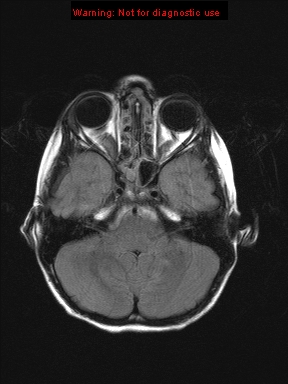 File:Neurofibromatosis type 1 with optic nerve glioma (Radiopaedia 16288-15965 Axial FLAIR 19).jpg
