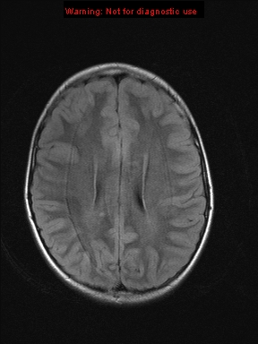 File:Neurofibromatosis type 1 with optic nerve glioma (Radiopaedia 16288-15965 Axial FLAIR 9).jpg