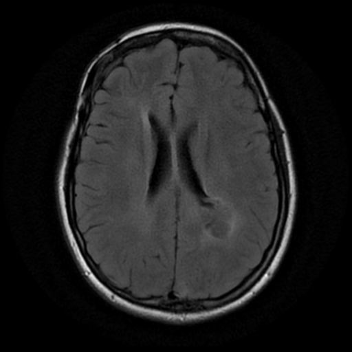 File:Neurofibromatosis type 2 (Radiopaedia 45229-49244 Axial FLAIR 13).png