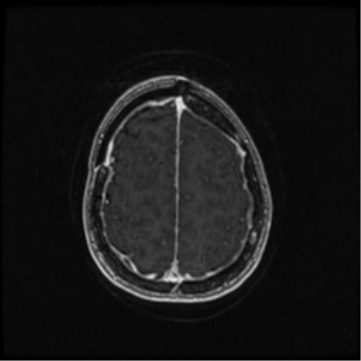 Neurofibromatosis type 2 (Radiopaedia 45229-49244 Axial T1 C+ 94).png