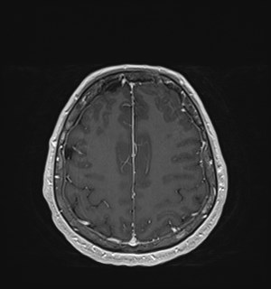 Neurofibromatosis type 2 (Radiopaedia 79097-92049 Axial T1 C+ 152).jpg