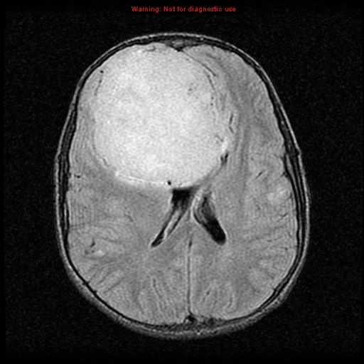 File:Neurofibromatosis type 2 (Radiopaedia 8953-9730 Axial FLAIR 16).jpg