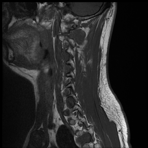 File:Neurofibromatosis type 2 (spinal manifestations) (Radiopaedia 53943-60070 Sagittal T1 11).png