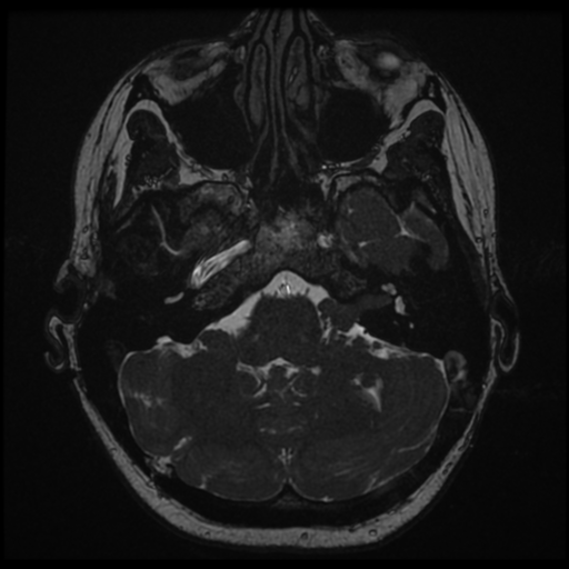 Neurofibromatosis type 2 - bilateral acoustic neuromata (Radiopaedia 40060-42566 Axial FIESTA 30).png