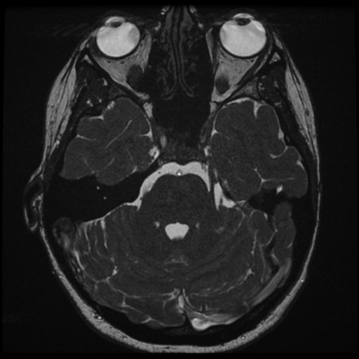 Neurofibromatosis type 2 - bilateral acoustic neuromata (Radiopaedia 40060-42566 Axial FIESTA 54).png