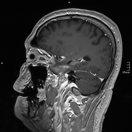 Neurosarcoidosis - involvement of the mesial temporal lobes (Radiopaedia 67429-76820 Sagittal T1 C+ 56).jpg