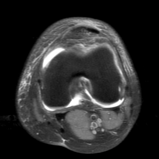 File:Non-displaced patella fracture (Radiopaedia 15932-15582 Axial PD fat sat 13).jpg