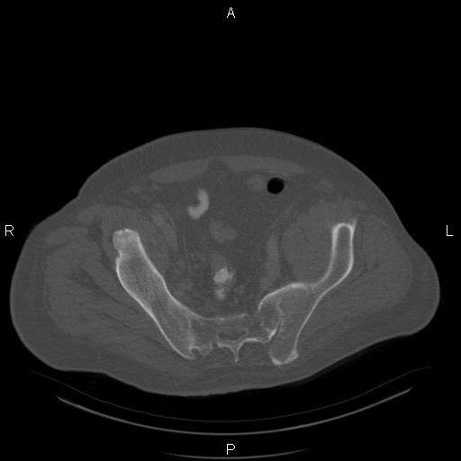 Non Hodgkin lymphoma in a patient with ankylosing spondylitis (Radiopaedia 84323-99624 Axial bone window 56).jpg