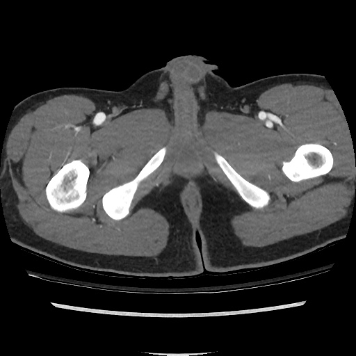 File:Normal CT angiogram of pelvis (Radiopaedia 45390-49430 A 58).jpg