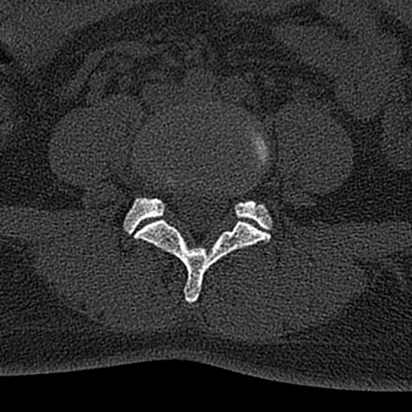 File:Normal CT lumbar spine (Radiopaedia 53981-60118 Axial bone window 52).jpg