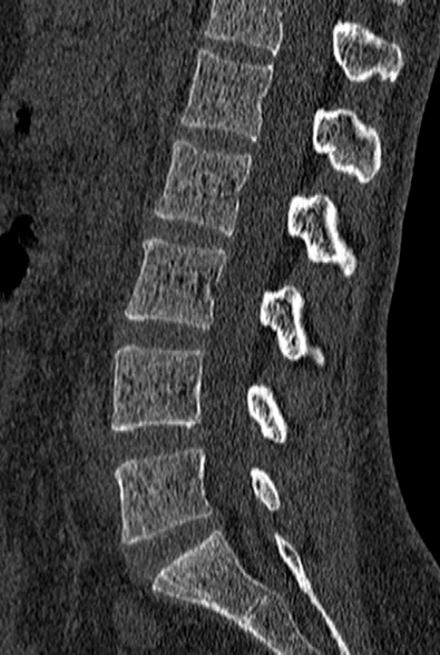 File:Normal CT lumbar spine (Radiopaedia 53981-60118 Sagittal bone window 50).jpg