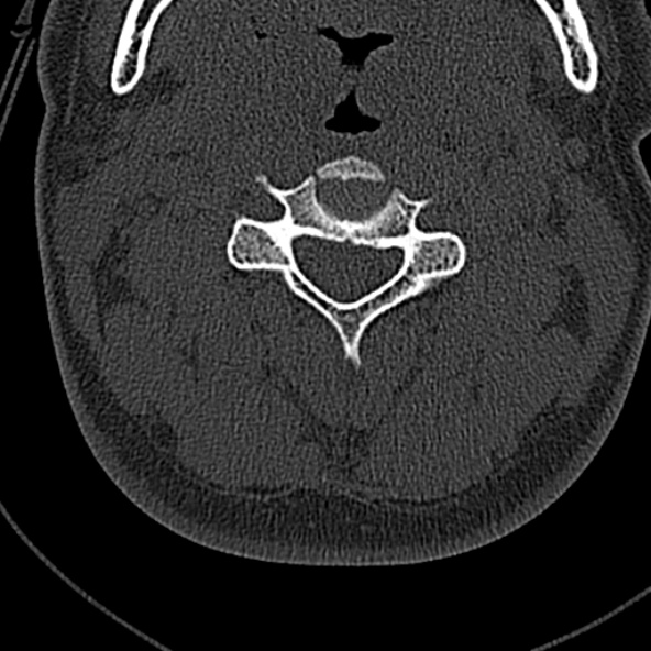 File:Normal CT of the cervical spine (Radiopaedia 53322-59305 Axial bone window 103).jpg