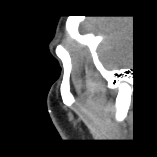 Normal CT paranasal sinuses (Radiopaedia 42286-45390 F 127).jpg
