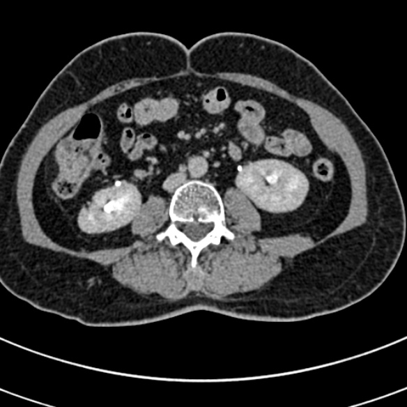 File:Normal CT split bolus study of the renal tract (Radiopaedia 48631-53634 Axial split bolus 133).jpg
