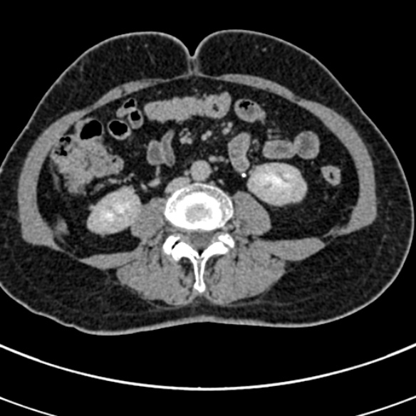 File:Normal CT split bolus study of the renal tract (Radiopaedia 48631-53634 Axial split bolus 143).jpg