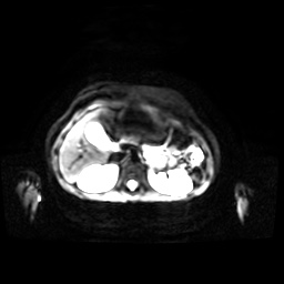 Normal MRI abdomen in pregnancy (Radiopaedia 88001-104541 Axial DWI 40).jpg