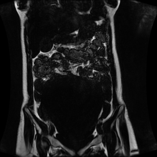 Normal MRI abdomen in pregnancy (Radiopaedia 88001-104541 N 54).jpg