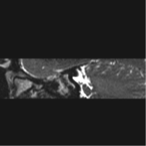 Normal MRI internal auditory canal (Radiopaedia 41613-44525 C 84).png