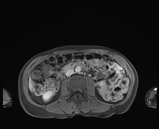 Normal adrenal glands MRI (Radiopaedia 82017-96004 M 52).jpg