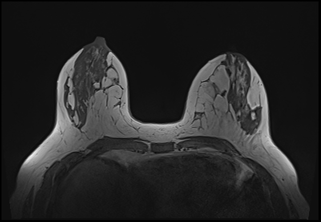 File:Normal breast MRI - dense breasts (Radiopaedia 80454-93850 Axial T1 84).jpg