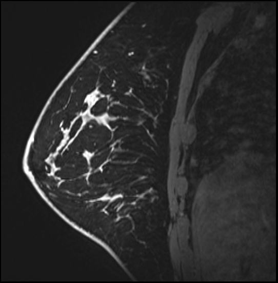 Normal breast MRI - dense breasts (Radiopaedia 80454-93850 I 126).jpg
