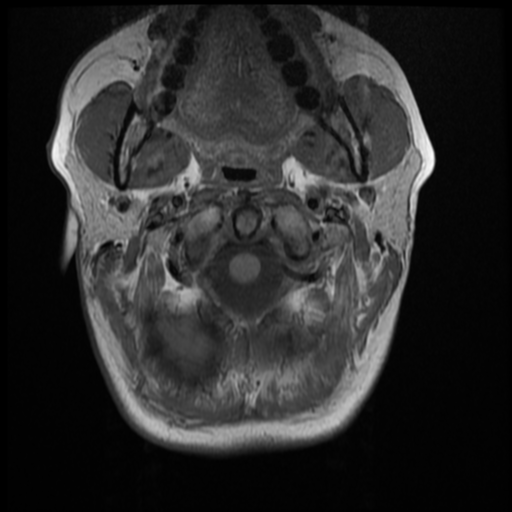 File:Normal cervical and thoracic spine MRI (Radiopaedia 35630-37156 Axial T1 31).png