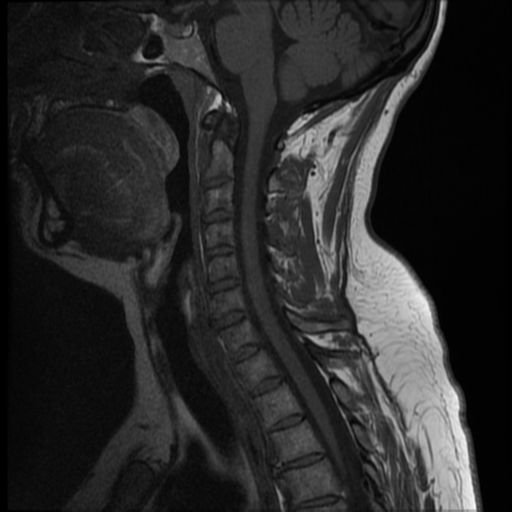 File:Normal cervical and thoracic spine MRI (Radiopaedia 35630-37156 Sagittal T1 7).png