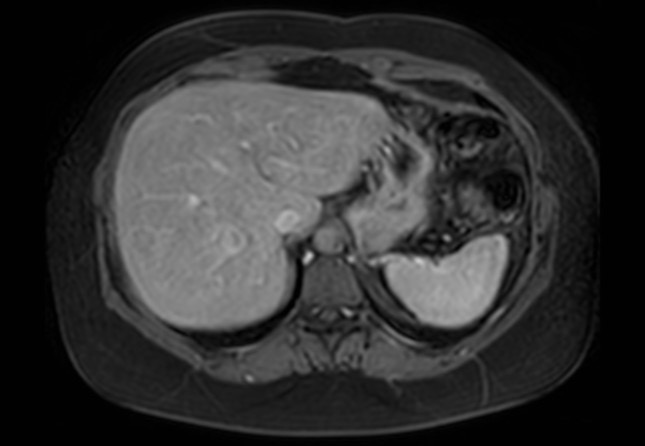 Normal liver MRI with Gadolinium (Radiopaedia 58913-66163 J 56).jpg