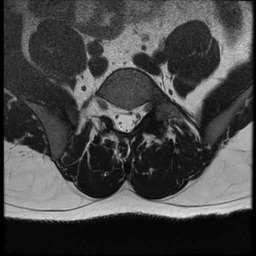 File:Normal lumbar spine MRI (Radiopaedia 35543-37039 Axial T2 9).png