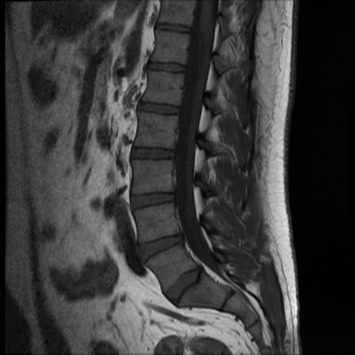 File:Normal lumbar spine MRI (Radiopaedia 35543-37039 Sagittal T1 6).png