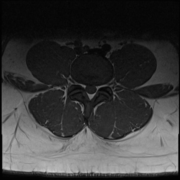 File:Normal lumbar spine MRI (Radiopaedia 47857-52609 Axial T1 18).jpg