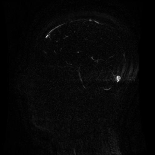 Normal noncontrast MR venography (Radiopaedia 87578-103957 A 82).jpg