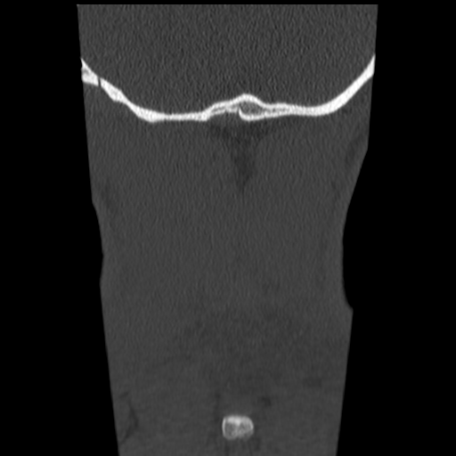 File:Normal trauma cervical spine (Radiopaedia 41017-43760 Coronal bone window 50).png