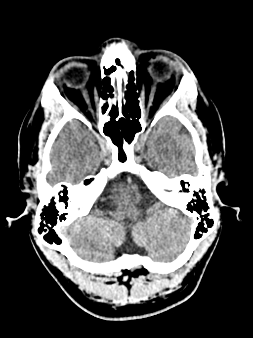 Normal trauma protocol brain and C-spine CT (Radiopaedia 83302-97709 Axial non-contrast 56).jpg
