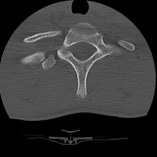 File:Normal trauma spine imaging (age 16) (Radiopaedia 45335-49358 Axial bone window 70).jpg