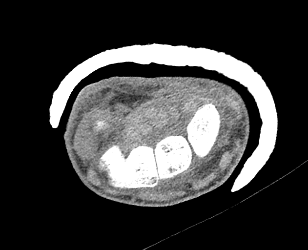 Normal wrist CT (Radiopaedia 41425-44297 Axial non-contrast 28).png