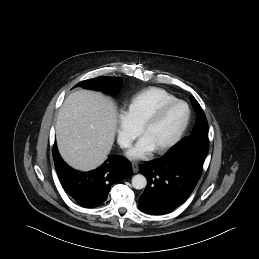 Obstructing sigmoid adenocarcinoma (Radiopaedia 58465-65619 A 16).jpg