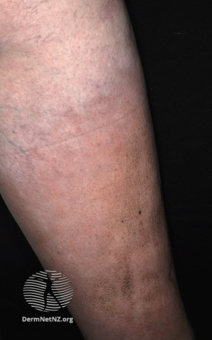 File:Pretibial myxoedema in Graves disease (DermNet NZ dermal-infiltrative-pretibial-myxoedema-14).jpg