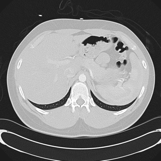 File:'Bovine' aortic arch (Radiopaedia 33554-34637 Axial lung window 63).png